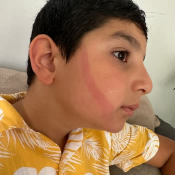 Johnsons Baby Şampuanın Cildi Tahriş Etmesi