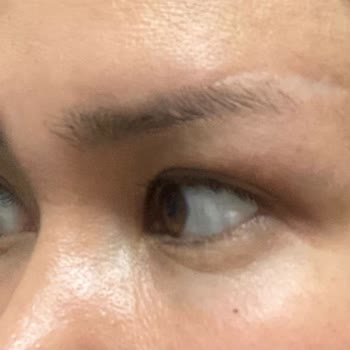 Sym Estetik Kaş Kaldırma Ameliyatı İz Problemi