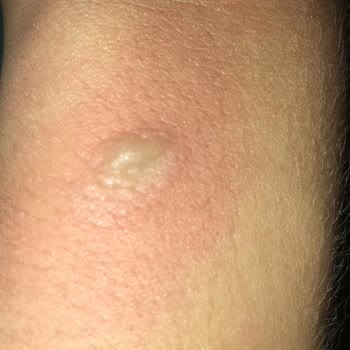 Turkcell Kolda Yanma Yaptı