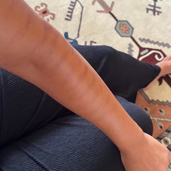 Ayşegül Mut Güzellik Merkezi Lazer Epilasyon Kolumu Yaktılar