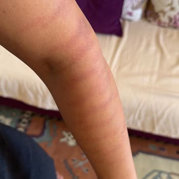 Ayşegül Mut Güzellik Merkezi Lazer Epilasyon Kolumu Yaktılar