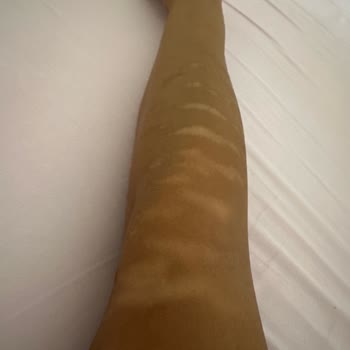 Ayşegül Mut Güzellik Merkezi Lazer Epilasyon Kolumu Yaktılar