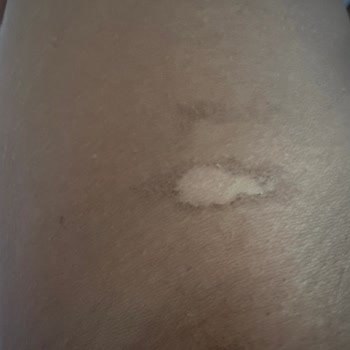 Ayşegül Mut Güzellik Merkezi Lazer Epilasyon Kolumu Yaktılar