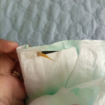 Molfix Bezin Kenarında Yabancı Cisim