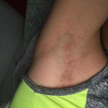 Tereson Yanık Leke Acı