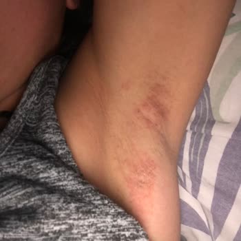 Tereson Yanık Leke Acı