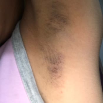 Tereson Yanık Leke Acı