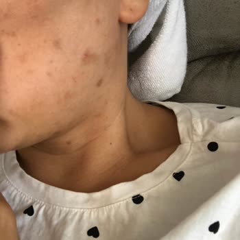 Flormar Mat Yüzümü Sivilce Doldurdu
