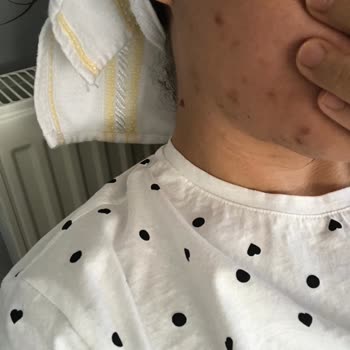 Flormar Mat Yüzümü Sivilce Doldurdu