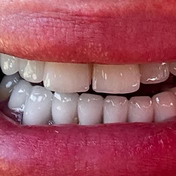 İmpladent Diş Kliniği'nde Yeni Dişlerimle Mağdur Oldum