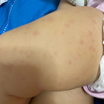 Mustela Güneş Kremi Alerji Yaptı