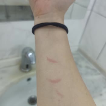 Adven Vip Güzellik Merkezi (Çukurambar) Lazer Epilasyon Yanığı