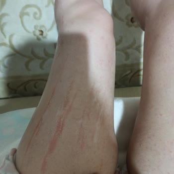 Adven Vip Güzellik Merkezi (Çukurambar) Lazer Epilasyon Yanığı