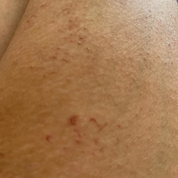 Novar Poliklinik Lazer Epilasyon Merkezi Hakkında Şikayet