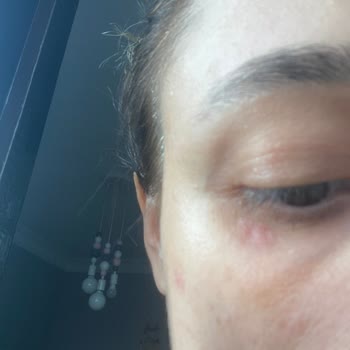 Estee Lauder Seyahat Boy Şişlik Kızarıklık Ve Kaşınma Yaptı
