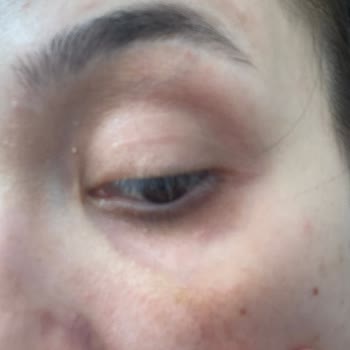 Estee Lauder Seyahat Boy Şişlik Kızarıklık Ve Kaşınma Yaptı