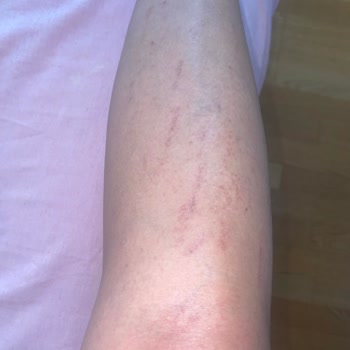 Aris Çukurambar Ezgi Doğan'da Lazer Seansı Sonrası Yaşadığım Sorunlar