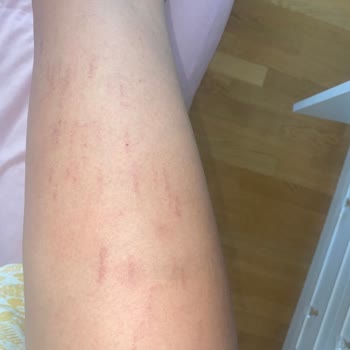 Aris Çukurambar Ezgi Doğan'da Lazer Seansı Sonrası Yaşadığım Sorunlar