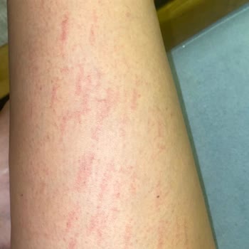 Aris Çukurambar Ezgi Doğan'da Lazer Seansı Sonrası Yaşadığım Sorunlar