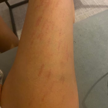 Aris Çukurambar Ezgi Doğan'da Lazer Seansı Sonrası Yaşadığım Sorunlar