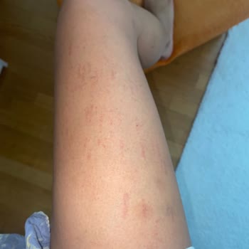 Aris Çukurambar Ezgi Doğan'da Lazer Seansı Sonrası Yaşadığım Sorunlar