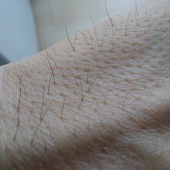 Bercislina Güzellik Merkezi Eskişehir Buz Lazer Epilasyonu Hüsranı