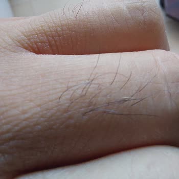 Bercislina Güzellik Merkezi Eskişehir Buz Lazer Epilasyonu Hüsranı