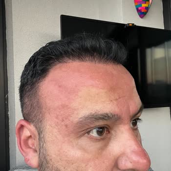 Sebamed Şampuan Vücutta Yanma Yapıyor