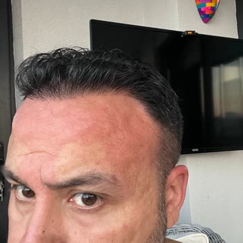 Sebamed Şampuan Vücutta Yanma Yapıyor