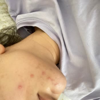 Yves Rocher Pure Menthe Sivilce Yaptı