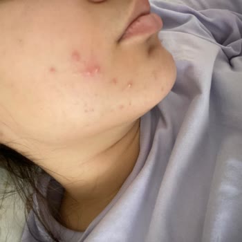 Yves Rocher Pure Menthe Sivilce Yaptı