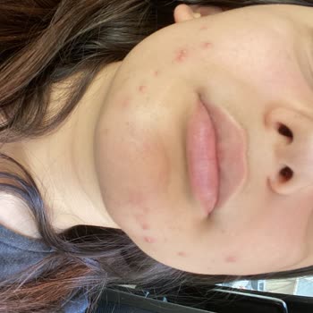 Yves Rocher Pure Menthe Sivilce Yaptı