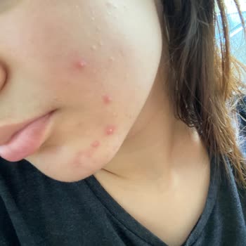 Yves Rocher Pure Menthe Sivilce Yaptı