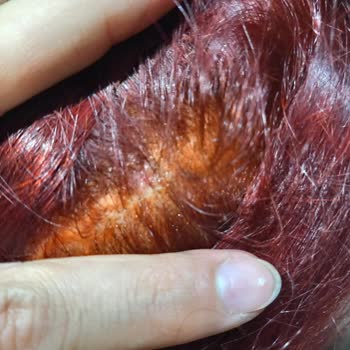 Antalya Kuaförler ve Manikürcüler Esnaf Sanatkarlar Odası Saç Boyatma Ve Acı