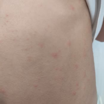 Bioderma Krem Kullanımı Sonrası Kızarıklıklar