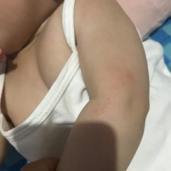 Mustela Güneş Kremi Bebeğimin Vücudunu Mahvetti