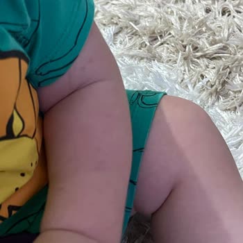 Mustela Güneş Kremi Alerji!