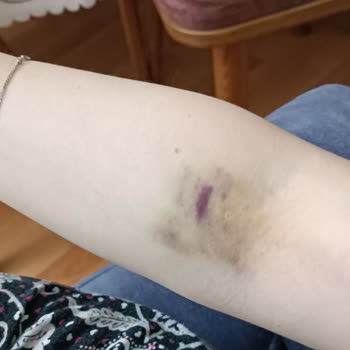 Liv Hospital Ankara Acil Servis Hemşire Hatası