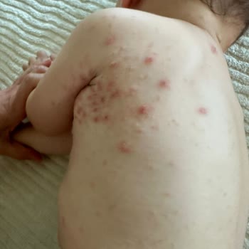 Dr. Talha Akil 3 Doktorun Teşhis Edemediği Uyuz Hastalığı