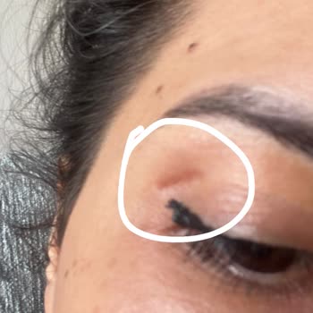 Op. Dr. Aykut Mısırlıoğlu Göz Kapağı Estetiği Sonrası Oluşan İzlerden Memnun Kalmadım