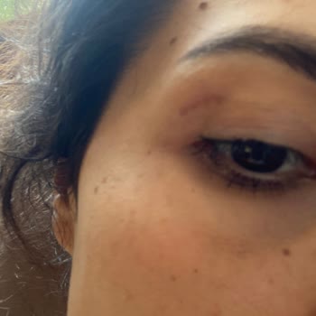 Op. Dr. Aykut Mısırlıoğlu Göz Kapağı Estetiği Sonrası Oluşan İzlerden Memnun Kalmadım