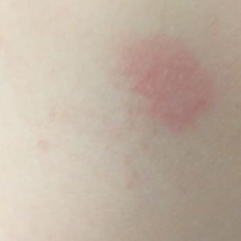 Eker Kefir Acı Tat Ve Şişmiş Kapak