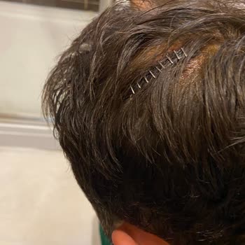 Şişli Hamidiye Etfal Eğitim Ve Araştırma Hastanesi Yanlış Atılan Dikiş!