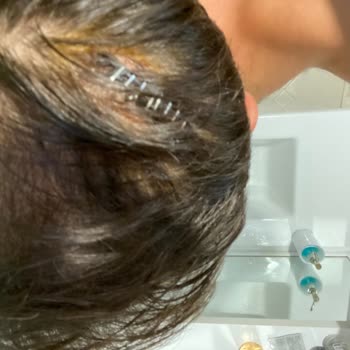 Şişli Hamidiye Etfal Eğitim Ve Araştırma Hastanesi Yanlış Atılan Dikiş!