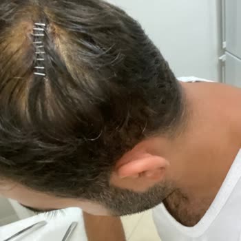 Şişli Hamidiye Etfal Eğitim Ve Araştırma Hastanesi Yanlış Atılan Dikiş!