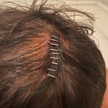 Şişli Hamidiye Etfal Eğitim Ve Araştırma Hastanesi Yanlış Atılan Dikiş!