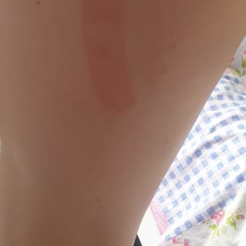 Cansın Sağlık Gereçleri Alerji Yapan Yarabandı