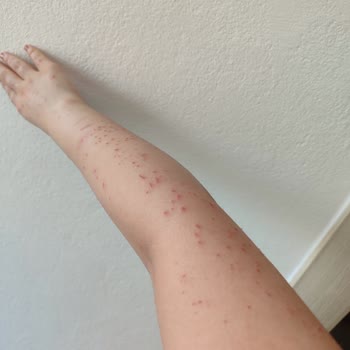 Alen Vip Güzellik Merkezi (Şanlıurfa) Yanlış İşlem Sonucu Mağduriyet