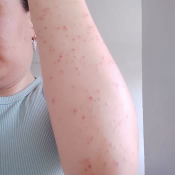 Alen Vip Güzellik Merkezi (Şanlıurfa) Yanlış İşlem Sonucu Mağduriyet