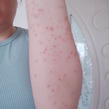 Alen Vip Güzellik Merkezi (Şanlıurfa) Yanlış İşlem Sonucu Mağduriyet